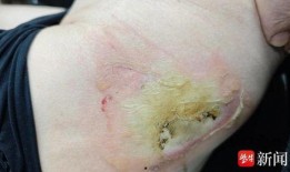 深二度烧伤图片,创伤后的皮肤修复与护理揭秘
