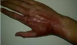 深二度烧伤图片,创伤后的皮肤修复与护理揭秘